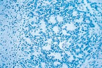 Neuroblastoma rosettes